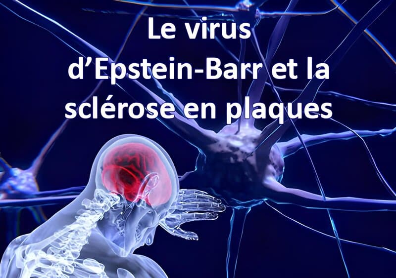 virus-epstein-barr-et-sclerose-plaques
